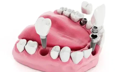 Ikon for Implantatprotetikk